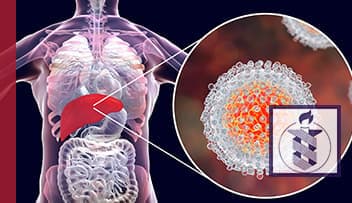 Chronic Hepatitis C: A Multifaceted Disease - 2 CME Credits